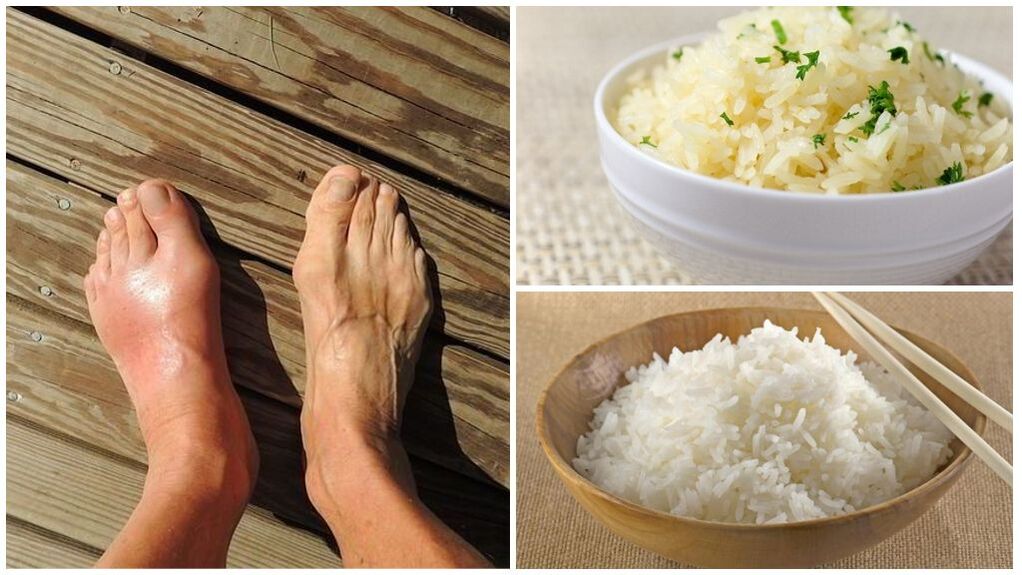 گاؤٹ کے مریضوں کے لیے چاول پر مبنی غذا تجویز کی جاتی ہے۔